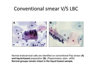 Conventional smear V/S LBC
Normal endocervical cells are identified on conventional Pap smear (A)
and liquid-based preparation (B). (Papanicolaou stain, x400)
Normal groups remain intact in the liquid based sample.
 