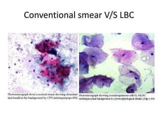 Conventional smear V/S LBC
 
