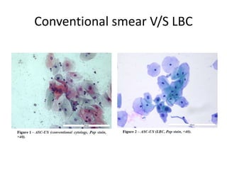 Conventional smear V/S LBC
 