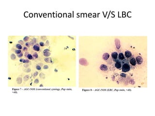 Conventional smear V/S LBC
 