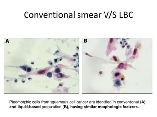 Conventional smear V/S LBC
Pleomorphic cells from squamous cell cancer are identified in conventional (A)
and liquid-based preparation (B), having similar morphologic features.
 
