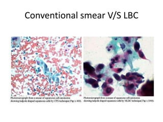Conventional smear V/S LBC
 
