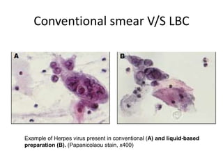 Conventional smear V/S LBC
Example of Herpes virus present in conventional (A) and liquid-based
preparation (B). (Papanicolaou stain, x400)
 