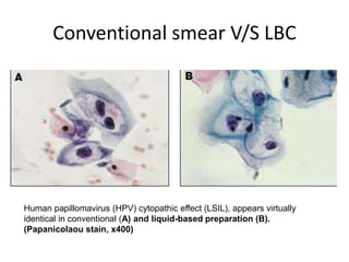 Conventional smear V/S LBC
Human papillomavirus (HPV) cytopathic effect (LSIL), appears virtually
identical in conventional (A) and liquid-based preparation (B).
(Papanicolaou stain, x400)
 