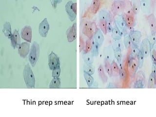Thin prep smear Surepath smear
 