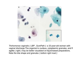 Trichomonas vaginalis ( LBP , SurePath ): a 32-year-old woman with
vaginal discharge.The organism’s nucleus, cytoplasmic granules, and fl
agella ( right ) may be better visualized on liquid-based preparations.
Note the kite shape and granules ( bottom right inset )
 