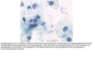 Candida species ( CP ): Torulopsis . Routine screening of a 63-year-old woman. Fungal organisms morphologically consistent with
Candida glabrata (previously known as Torulopsis glabrata ). Note clear halos surrounding the yeast forms ( left ). Bacteria, not
pseudohyphae, are also seen in the background. This organism does not form pseudohyphae and may be pathogenic in
immunocompromised individuals
 