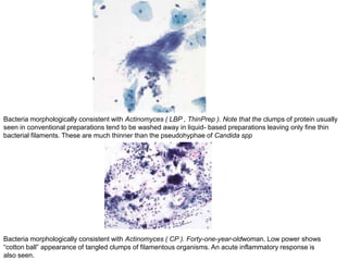 Bacteria morphologically consistent with Actinomyces ( LBP , ThinPrep ). Note that the clumps of protein usually
seen in conventional preparations tend to be washed away in liquid- based preparations leaving only fine thin
bacterial filaments. These are much thinner than the pseudohyphae of Candida spp
Bacteria morphologically consistent with Actinomyces ( CP ). Forty-one-year-oldwoman. Low power shows
“cotton ball” appearance of tangled clumps of filamentous organisms. An acute inflammatory response is
also seen.
 