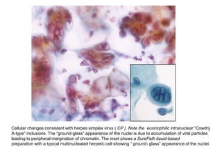 Cellular changes consistent with herpes simplex virus ( CP ). Note the eosinophilic intranuclear “Cowdry
A-type” inclusions. The “ground-glass” appearance of the nuclei is due to accumulation of viral particles
leading to peripheral margination of chromatin. The inset shows a SurePath liquid-based
preparation with a typical multinucleated herpetic cell showing “ ground- glass” appearance of the nuclei.
 