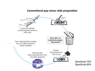 Conventional pap smear slide preparation
Sensitivity-72%
Specificity-94%
 