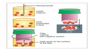 Lbc Testing Liquid Based Cytology by Dr Prashant pachuari | PPTX