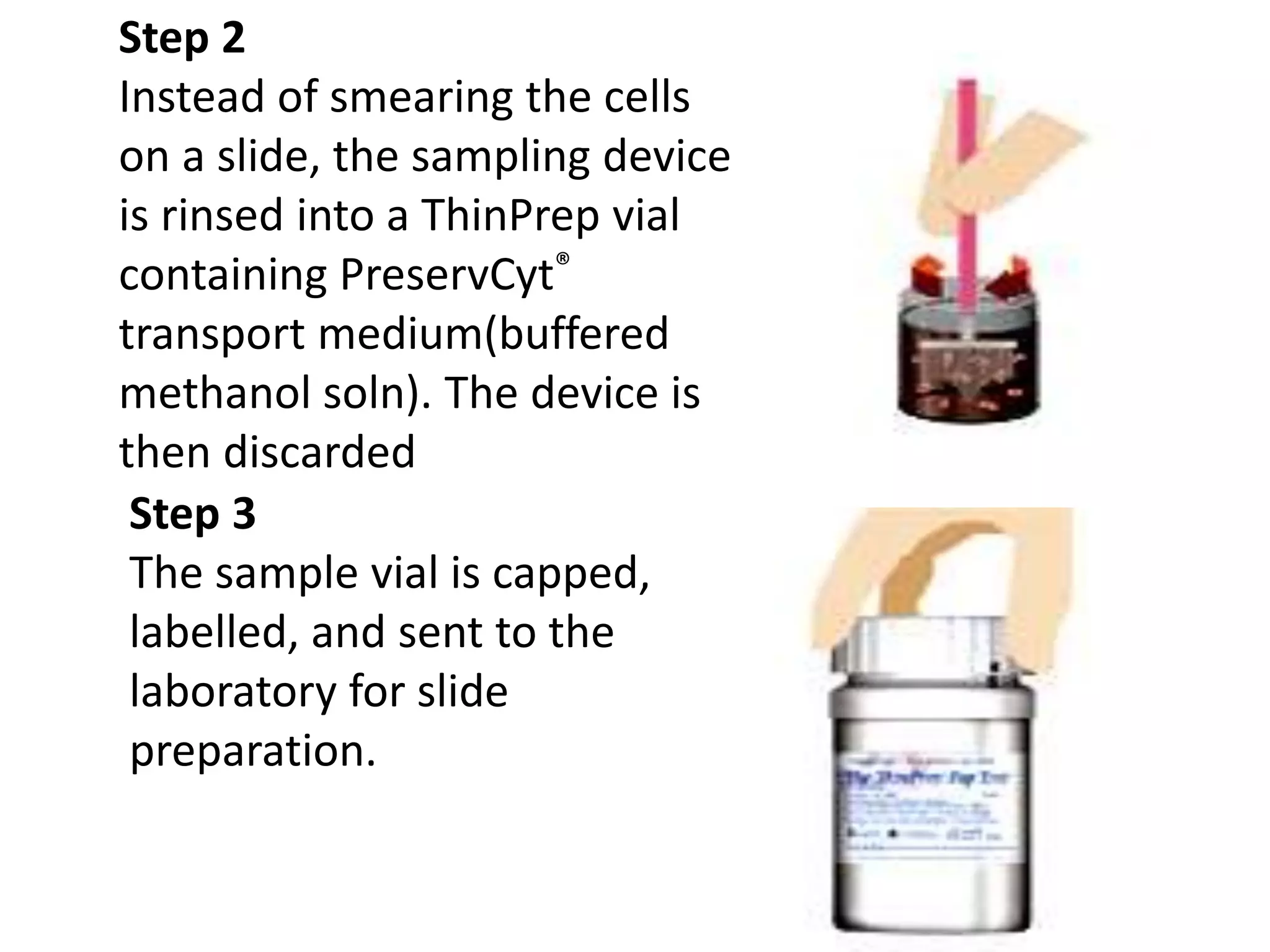 Step 2
Instead of smearing the cells
on a slide, the sampling device
is rinsed into a ThinPrep vial
containing PreservCyt®
transport medium(buffered
methanol soln). The device is
then discarded
Step 3
The sample vial is capped,
labelled, and sent to the
laboratory for slide
preparation.
 