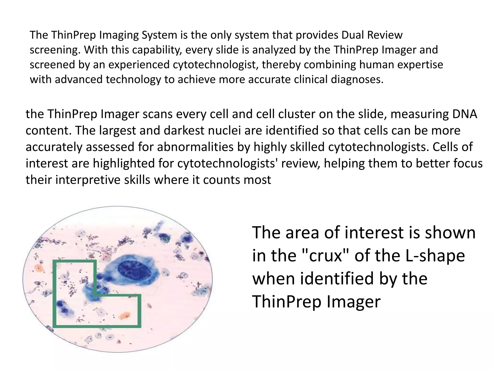 The ThinPrep Imaging System is the only system that provides Dual Review
screening. With this capability, every slide is analyzed by the ThinPrep Imager and
screened by an experienced cytotechnologist, thereby combining human expertise
with advanced technology to achieve more accurate clinical diagnoses.
the ThinPrep Imager scans every cell and cell cluster on the slide, measuring DNA
content. The largest and darkest nuclei are identified so that cells can be more
accurately assessed for abnormalities by highly skilled cytotechnologists. Cells of
interest are highlighted for cytotechnologists' review, helping them to better focus
their interpretive skills where it counts most
The area of interest is shown
in the "crux" of the L-shape
when identified by the
ThinPrep Imager
 