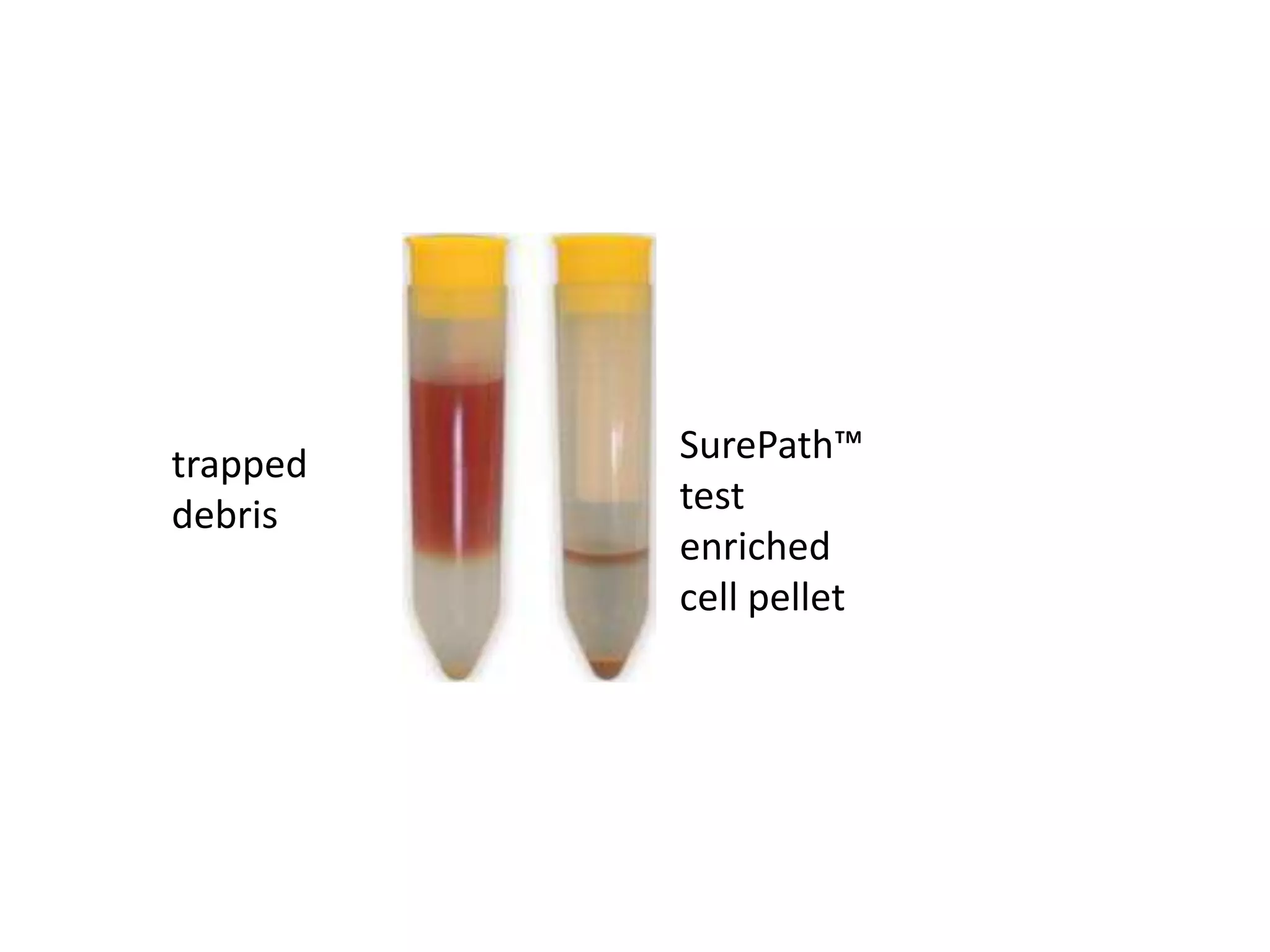trapped
debris
SurePath™
test
enriched
cell pellet
 
