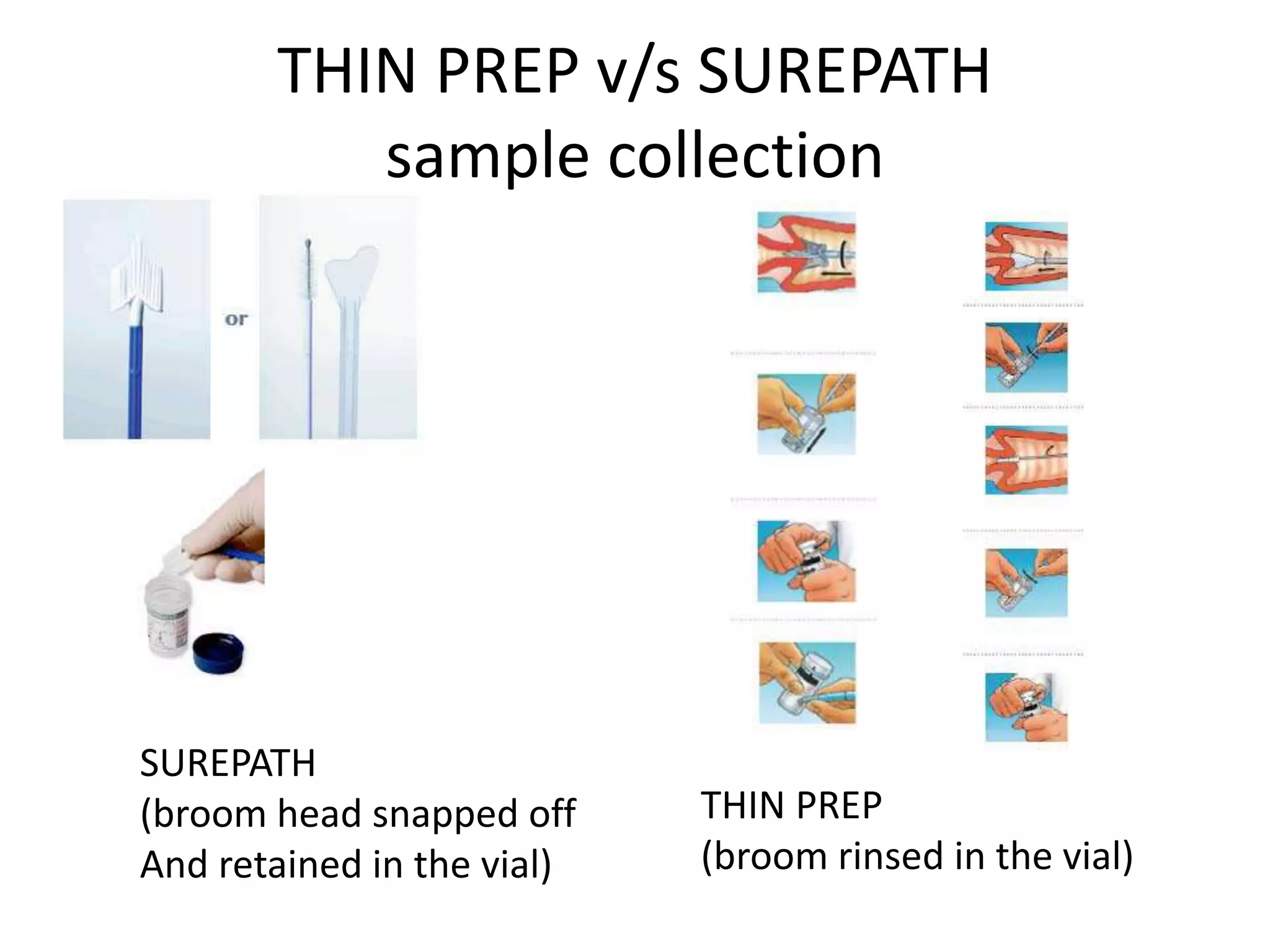 THIN PREP v/s SUREPATH
sample collection
THIN PREP
(broom rinsed in the vial)
SUREPATH
(broom head snapped off
And retained in the vial)
 