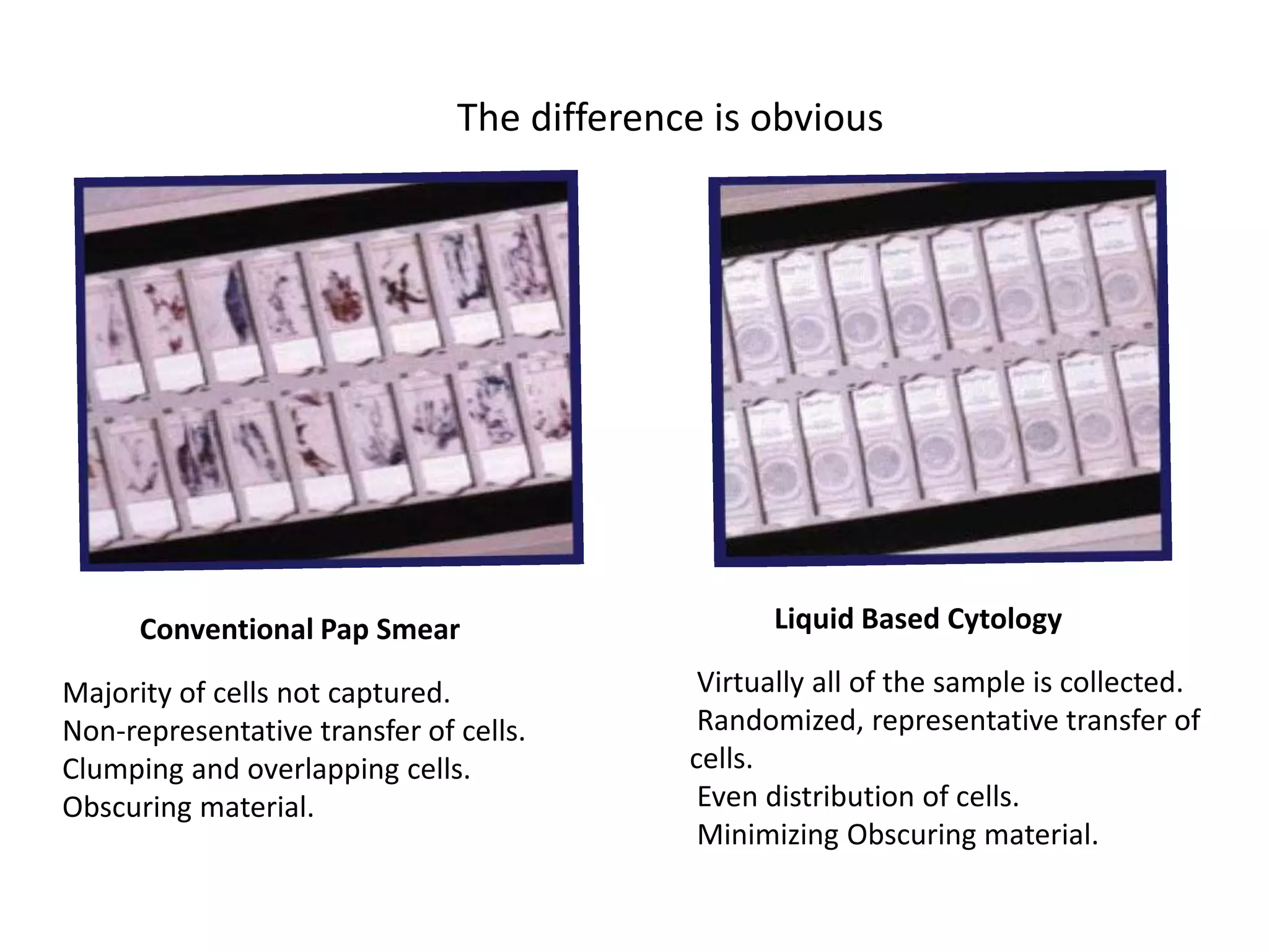 Conventional Pap Smear Liquid Based Cytology
Majority of cells not captured.
Non-representative transfer of cells.
Clumping and overlapping cells.
Obscuring material.
Virtually all of the sample is collected.
Randomized, representative transfer of
cells.
Even distribution of cells.
Minimizing Obscuring material.
The difference is obvious
 