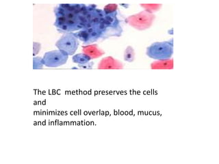 The LBC method preserves the cells
and
minimizes cell overlap, blood, mucus,
and inflammation.
 