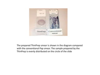 The prepared ThinPrep smear is shown in the diagram compared
with the conventional Pap smear. The sample prepared by the
ThinPrep is evenly distributed on the circle of the slide
 