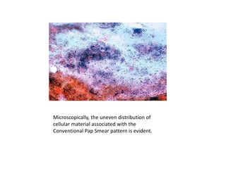 Microscopically, the uneven distribution of
cellular material associated with the
Conventional Pap Smear pattern is evident.
 