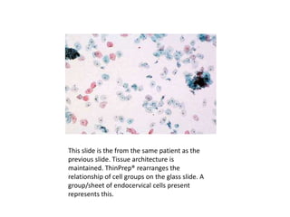 This slide is the from the same patient as the
previous slide. Tissue architecture is
maintained. ThinPrep® rearranges the
relationship of cell groups on the glass slide. A
group/sheet of endocervical cells present
represents this.
 