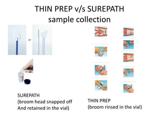 THIN PREP v/s SUREPATH
sample collection
THIN PREP
(broom rinsed in the vial)
SUREPATH
(broom head snapped off
And retained in the vial)
 