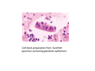 Cell block preparation from SurePath
specimen containing glandular epithelium
 