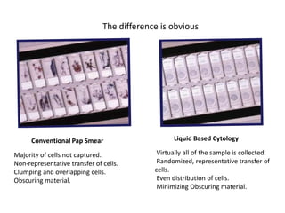 Conventional Pap Smear Liquid Based Cytology
Majority of cells not captured.
Non-representative transfer of cells.
Clumping and overlapping cells.
Obscuring material.
Virtually all of the sample is collected.
Randomized, representative transfer of
cells.
Even distribution of cells.
Minimizing Obscuring material.
The difference is obvious
 