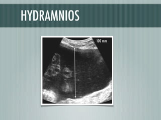 100 mm
HYDRAMNIOS
 