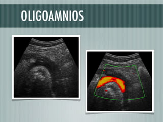 OLIGOAMNIOS
 