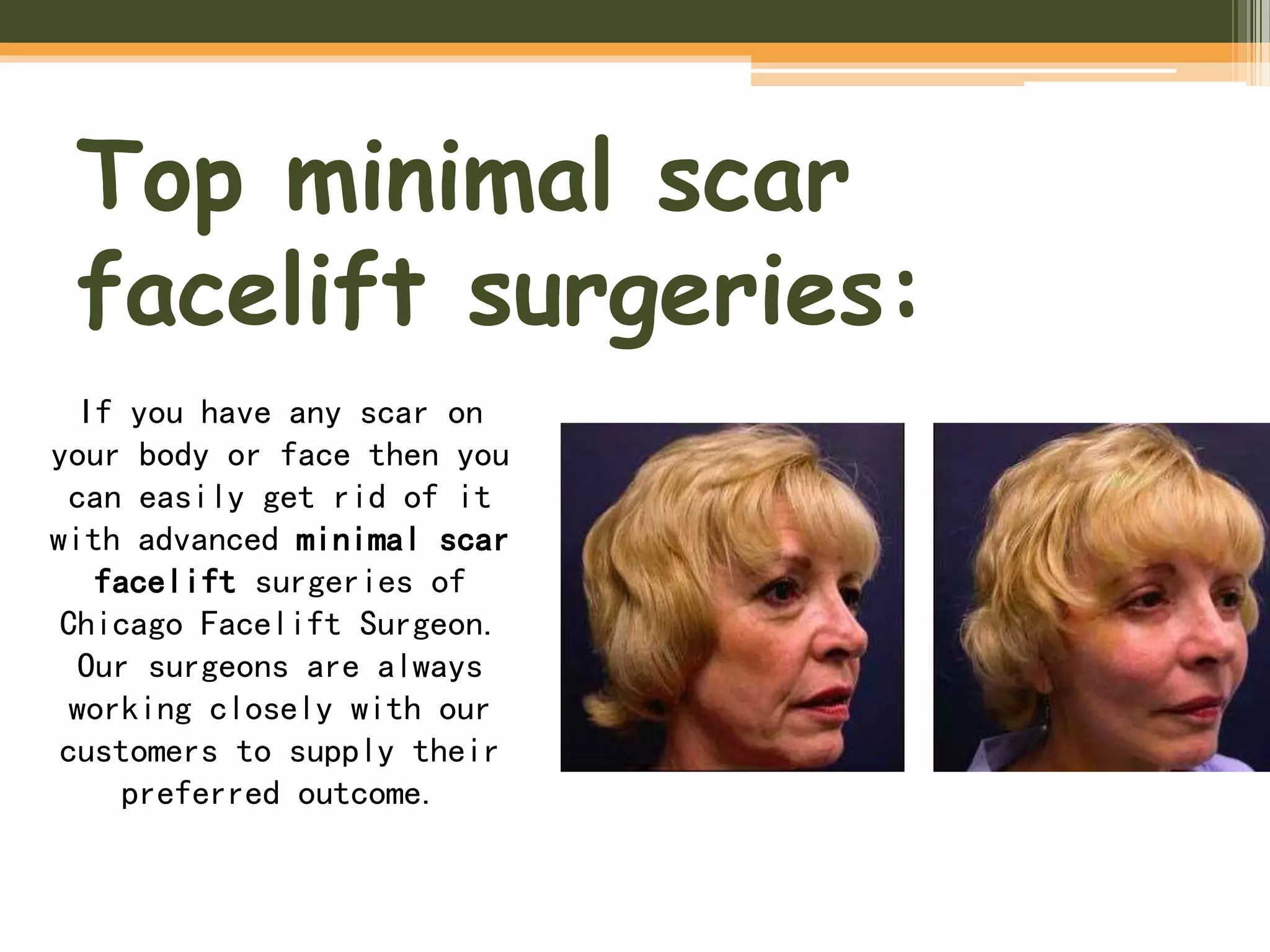 Now, Quicklift mini facelift cost Chicago is affordable PPT