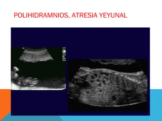 POLIHIDRAMNIOS, ATRESIA YEYUNAL
 