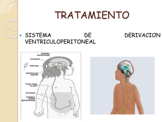 TRATAMIENTO
 SISTEMA DE DERIVACION
VENTRICULOPERITONEAL
 