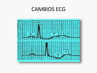 CAMBIOS ECG 
 