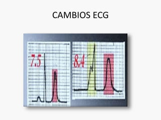 CAMBIOS ECG 
 