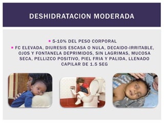 DESHIDRATACION MODERADA
 5-10% DEL PESO CORPORAL
 FC ELEVADA, DIURESIS ESCASA O NULA, DECAIDO-IRRITABLE,
OJOS Y FONTANELA DEPRIMIDOS, SIN LAGRIMAS, MUCOSA
SECA, PELLIZCO POSITIVO, PIEL FRIA Y PALIDA, LLENADO
CAPILAR DE 1.5 SEG
 