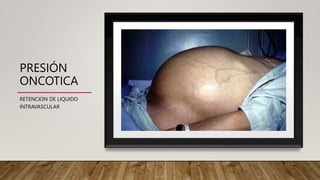PRESIÓN
ONCOTICA
RETENCION DE LIQUIDO
INTRAVASCULAR
 