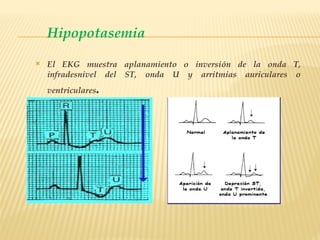  El EKG muestra aplanamiento o inversión de la onda T,
infradesnivel del ST, onda U y arritmias auriculares o
ventriculares.
Hipopotasemia
 