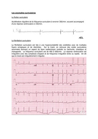 Les anomalies auriculaires

Le flutter auriculaire

Accélération régulière de la fréquence auriculaire à environ 300/min. souvent accompagné
d’une réponse ventriculaire à 150/min.




La fibrillation auriculaire

La fibrillation auriculaire est liée à une hyperexcitabilité des oreillettes avec de multiples
foyers ectopiques et de réentrées. Sur le tracé, on retrouve des ondes auriculaires
anormales donnant un aspect de ligne isoélectrique ondulée ou hachurée, chaotique et
changeante. La fréquence auriculaire est de 400 à 600/min. La réponse ventriculaire est
irrégulière avec des complexes d’aspect et de fréquence irrégulière lente ou rapide. On dit
que le tracé est irrégulièrement irrégulier.
 