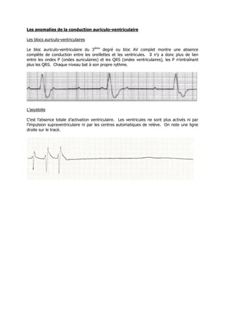 Les anomalies de la conduction auriculo-ventriculaire

Les blocs auriculo-ventriculaires

Le bloc auriculo-ventriculaire du 3ième degré ou bloc AV complet montre une absence
complète de conduction entre les oreillettes et les ventricules. Il n’y a donc plus de lien
entre les ondes P (ondes auriculaires) et les QRS (ondes ventriculaires), les P n’entraînant
plus les QRS. Chaque niveau bat à son propre rythme.




L’asystolie

C’est l’absence totale d’activation ventriculaire. Les ventricules ne sont plus activés ni par
l’impulsion supraventriculaire ni par les centres automatiques de relève. On note une ligne
droite sur le tracé.
 