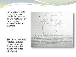  Por lo general esta
es la causa mas
común de fractura
de una restauración
de un borde
marginal o de las
cúspides
 El efecto cuña es la
resolución de los
componentes de
fuerza sobre los
planos inclinados
afectados
 