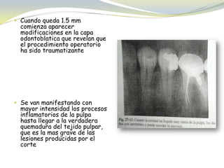  Cuando queda 1.5 mm
comienza aparecer
modificaciones en la capa
odontoblatica que revelan que
el procedimiento operatorio
ha sido traumatizante
 Se van manifestando con
mayor intensidad los procesos
inflamatorios de la pulpa
hasta llegar a la verdadera
quemadura del tejido pulpar,
que es la mas grave de las
lesiones producidas por el
corte
 