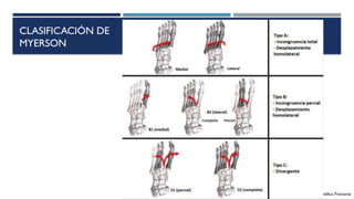 lesion luxofractura de lisfranc manejo.pptx