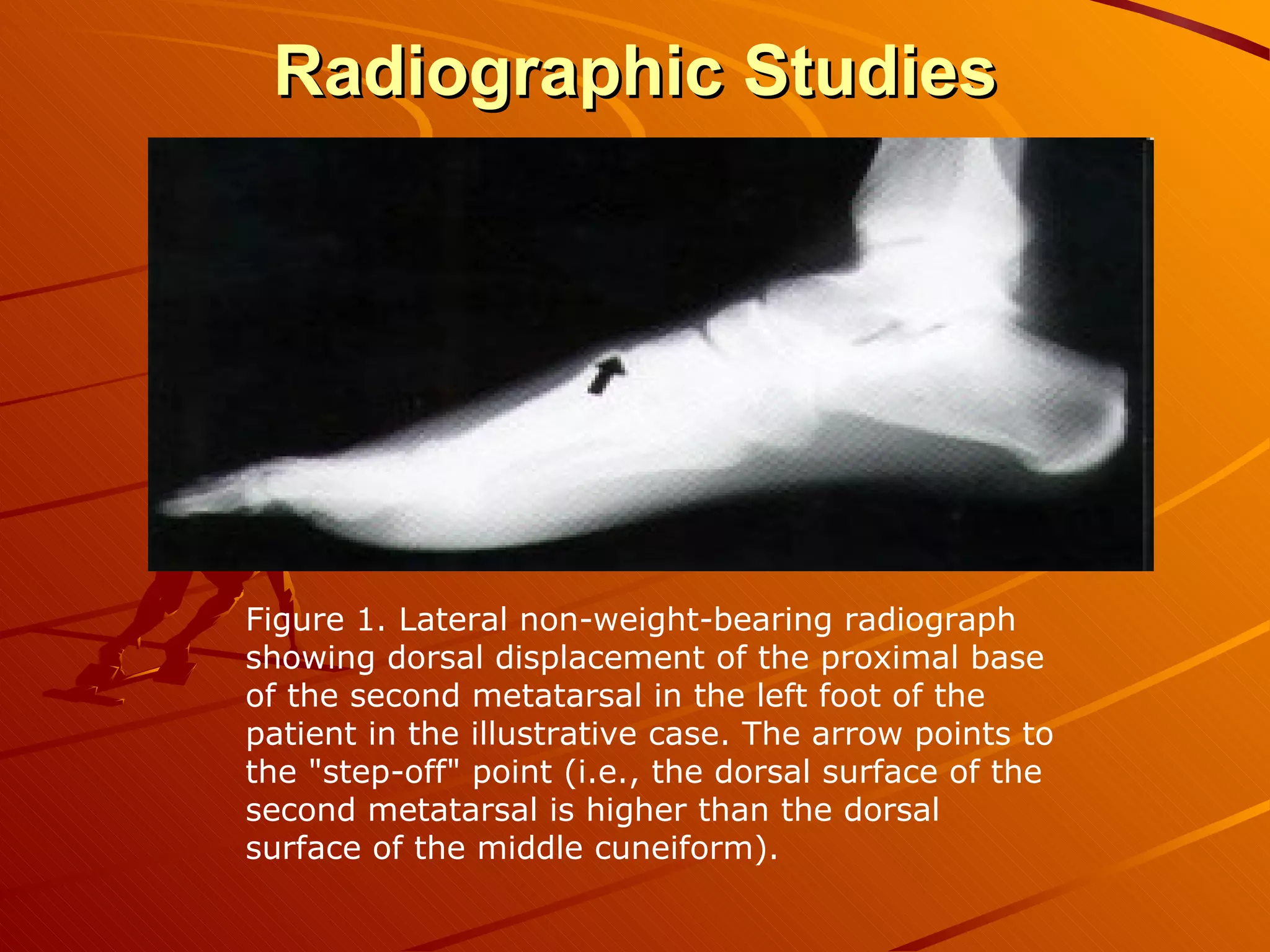 Radiographic Studies Figure 1. Lateral non­weight-bearing radiograph showing dorsal displacement of the proximal base of the second metatarsal in the left foot of the patient in the illustrative case. The arrow points to the "step-off" point (i.e., the dorsal surface of the second metatarsal is higher than the dorsal surface of the middle cuneiform).  