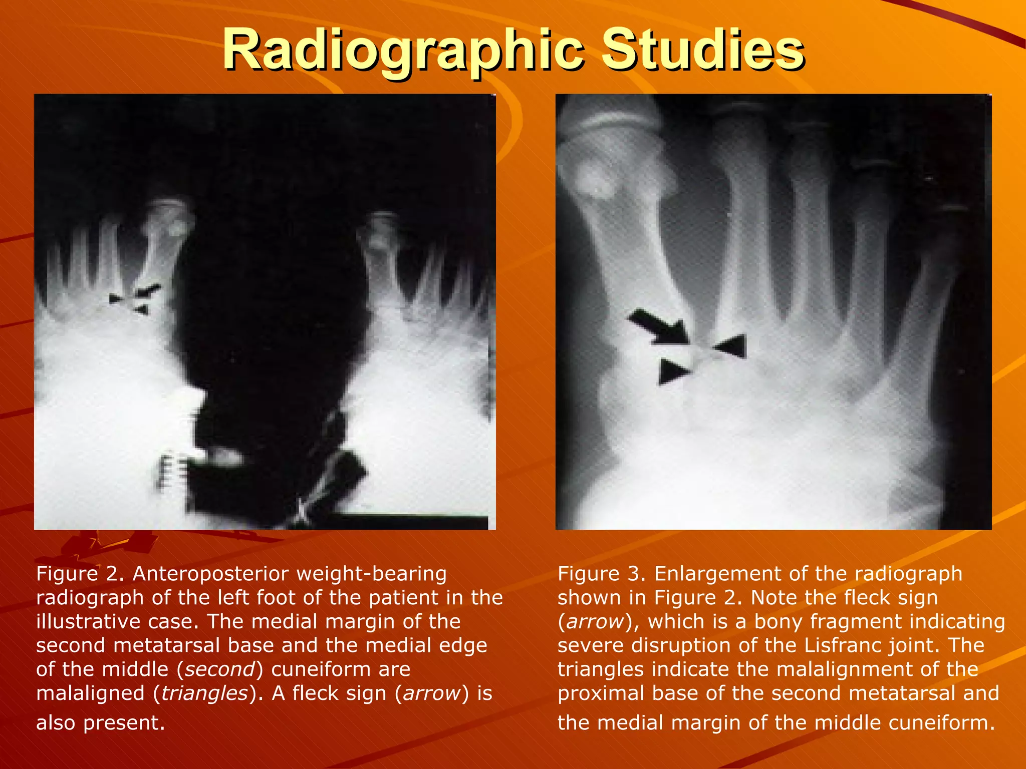 Radiographic Studies Figure 2. Anteroposterior weight-bearing radiograph of the left foot of the patient in the illustrative case. The medial margin of the second metatarsal base and the medial edge of the middle ( second ) cuneiform are malaligned ( triangles ). A fleck sign ( arrow ) is also present.   Figure 3. Enlargement of the radiograph shown in Figure 2. Note the fleck sign ( arrow ), which is a bony fragment indicating severe disruption of the Lisfranc joint. The triangles indicate the malalignment of the proximal base of the second metatarsal and the medial margin of the middle cuneiform.   