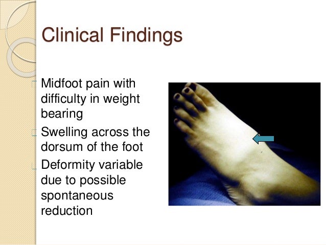 Lisfranc injury