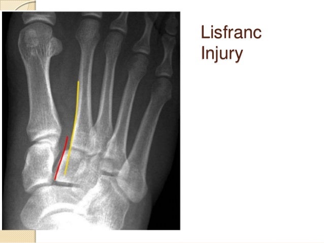Lisfranc injury
