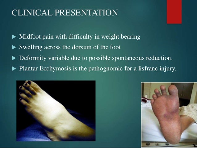 Lisfranc injury