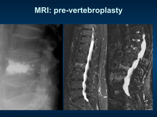 MRI: pre-vertebroplasty
STIR
 