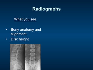 Radiographs
What you see
•  Bony anatomy and
alignment
•  Disc height
 