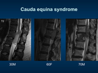 Cauda equina syndrome
30M 60F 70M
T2
 